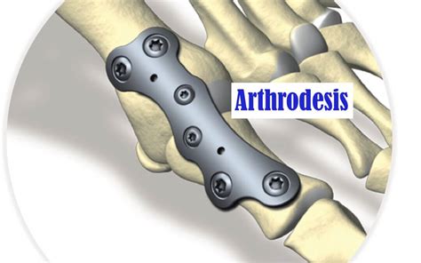 arthrodesis pip joint toe cpt.